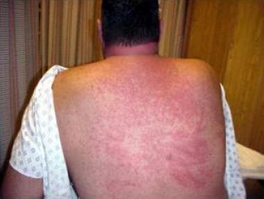 Diffuse maculopapular rash in toxic epidermal necr