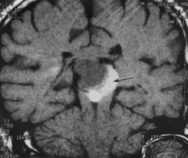 Noncontrast MRI of a pineocytoma in a 40-year-old 