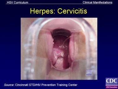 单纯疱疹病毒(HSV)宫颈炎可累及