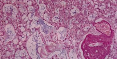 Myxopapillary ependymoma. Clusters of loosely arra