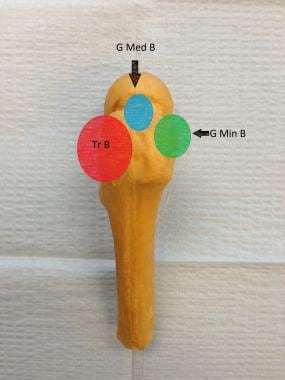 Tr B = trochanteric bursa; G Med B = subgluteus me