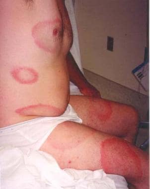 Lyme disease. Multiple lesions of erythema migrans