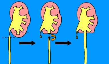 Diagram of ureterocalicostomy procedure. The left 