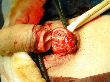 Penile amputation in the initial stage of replanta