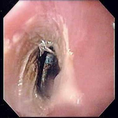 Endoscopic view of disk battery in esophagus of a 