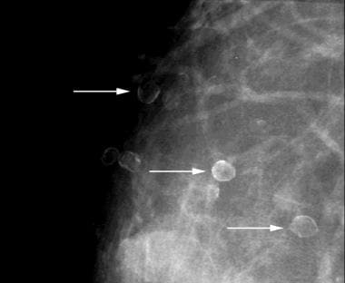 Eggshell or rim calcifications (arrows) have walls