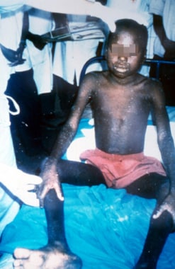 Boy with monkeypox in Democratic Republic of the C