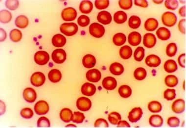 Peripheral blood smear shows Howell-Jolly (HJ) bod