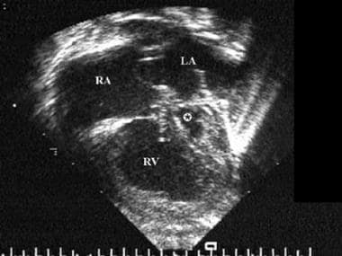 This echocardiographic still frame shows a 4-chamb