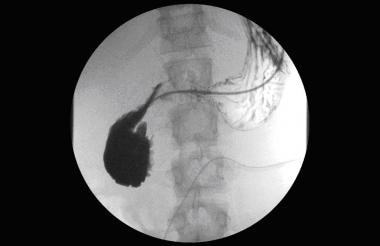 Prompt gastric emptying of residual contrast is pr