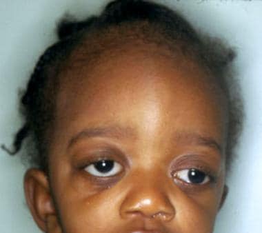 Child with Crouzon syndrome. Note midfacial hypopl