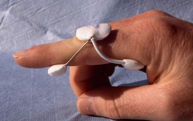Dynamic spring extension splint for the treatment 