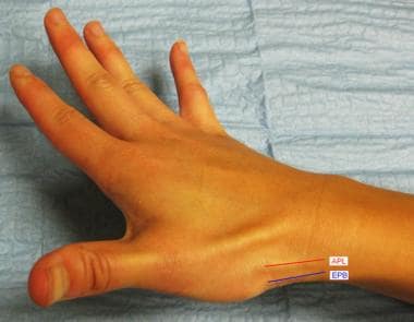 First dorsal compartment of hand, including abduct