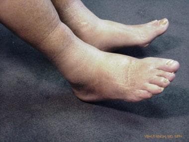 Bilateral pitting edema in a patient with congesti