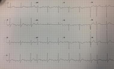 Twelve-lead ECG showing atrial flutter with variab