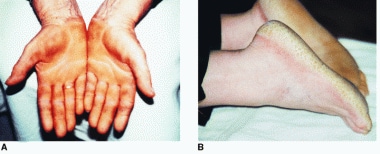 Palmoplantar keratoderma (tylosis) of palms (A) an