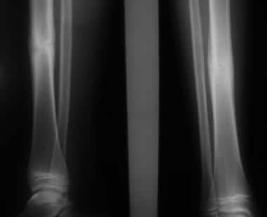 Growth plate (physeal) fractures. Healed tibia sha