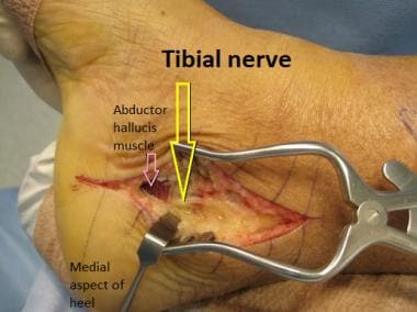 Common Questions after Tarsal Tunnel Surgery