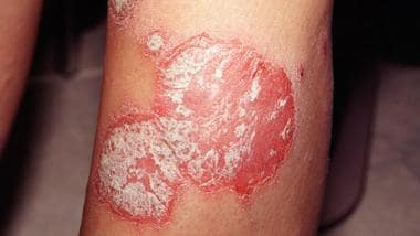 Plaque psoriasis. Courtesy of University of Britis