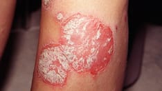 kentucky glp-1 gastrointestinal obstruction attorney Kentucky Wight Loss Drug Attorney