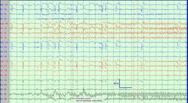 Ictal EEG recording of right temporal lobe epileps