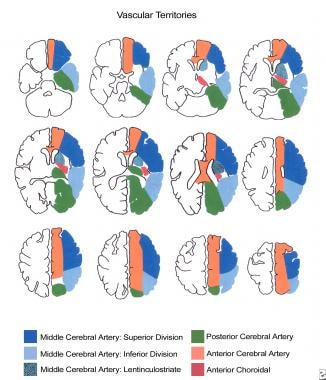 Anterior Circulation Stroke: Origins and Sites of Occlusion ...