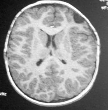Craniosynostosis management. MRI examination of th