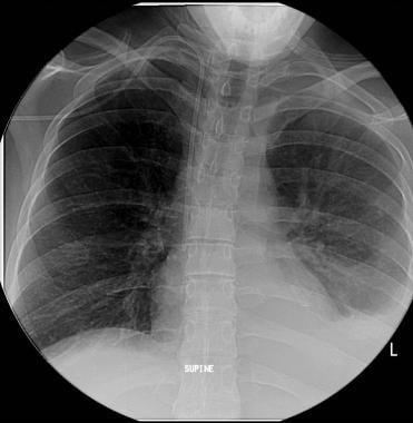 Check chest radiograph at completion. 