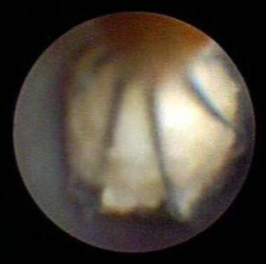 Image shows stone trapped endoscopically in stone 