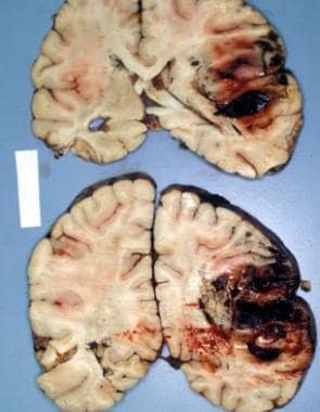 Traumatic intracerebral hemorrhage in the right fr