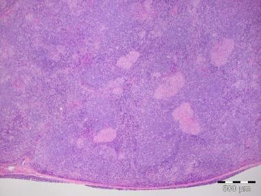 toxoplasmosis brain pathology