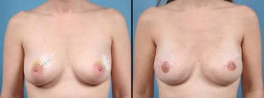 Acellular dermis–assisted 2-stage bilateral breast