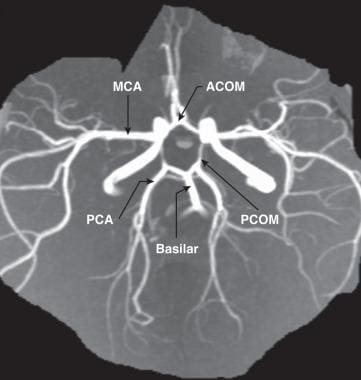 Magnetic resonance arteriography illustrating the 
