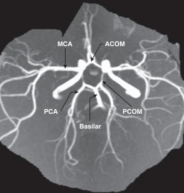 circle of willis brain