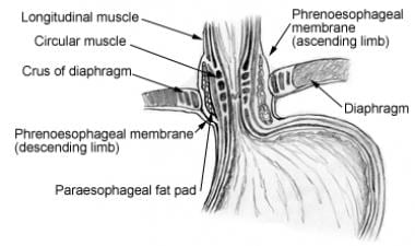 Laparoscopic Nissen Fundoplication Technique: Laparoscopic Nissen  Fundoplication, Complications