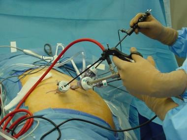 Port positioning for laparoscopic right adrenalect