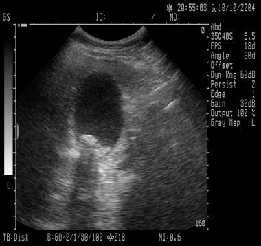 Acute Cholecystitis and Biliary Colic. The sonogra