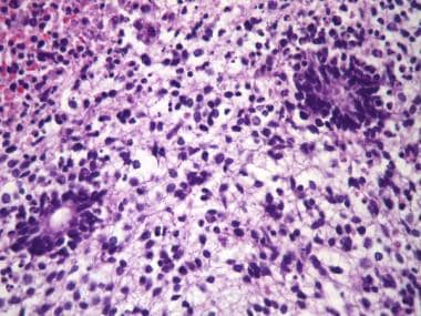 Pathology of Embryonal Tumors. An embryonal tumor 