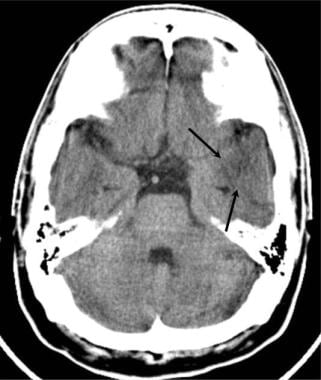 Brain abscess. Axial nonenhanced cranial CT scan i