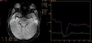 Regions of interest are selected for arterial and 