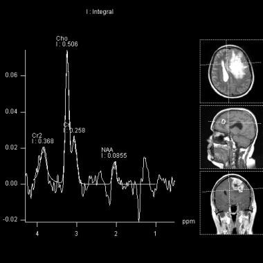 This MR spectroscopy of the previous MRI demonstra