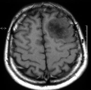 Axial T1-weighted magnetic resonance image of a lo