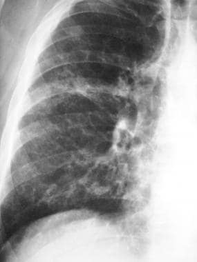 Magnified view of the right lung base shows reticu