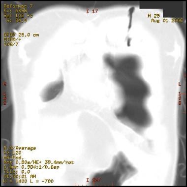 Coronal computed tomography scan of the thorax see