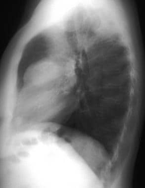Lateral chest radiograph in the same patient as in