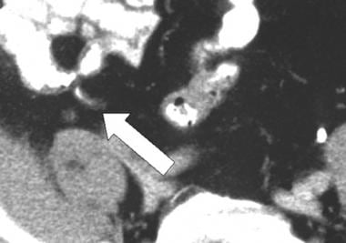Normal appendix; computed tomography (CT) scan. A 