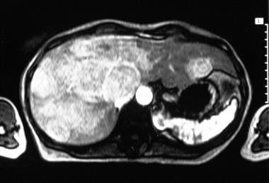 Characteristic appearance of carcinoid liver metas