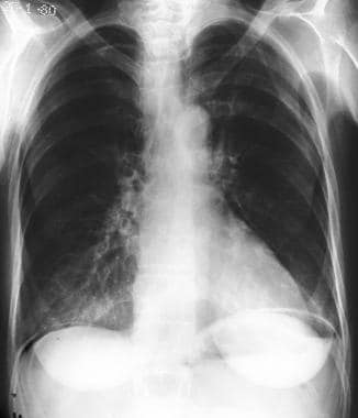 Pneumoperitoneum. Upright chest radiograph shows a