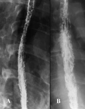 Infectious esophagitis. Two examples of advanced C