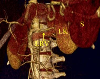 Three-dimensional color-shaded CT angiography of t